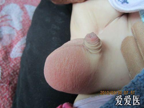 小儿腹股沟斜疝术后阴囊血肿