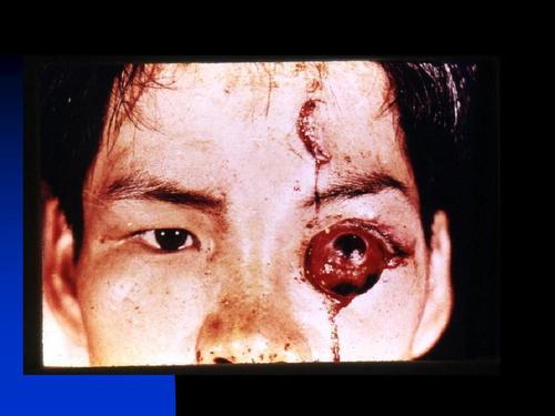 眼外伤分析ppt课件