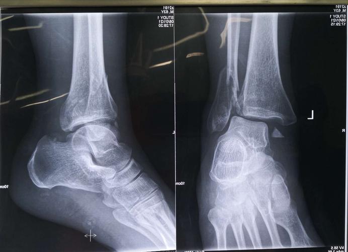 踝关节后外侧联合内侧手术入路治疗三踝骨折