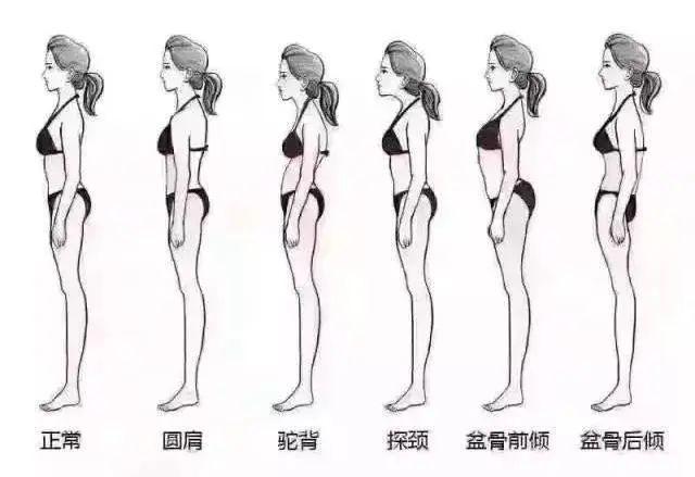 1. 什么是骨盆前倾