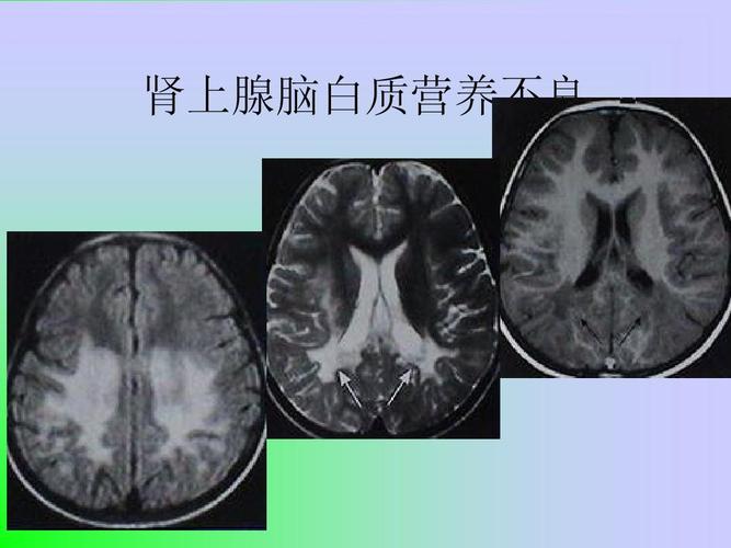 脑变性和脑白质病ppt