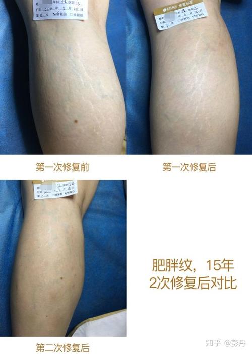 我真的有好多肥胖纹,感到很自卑?