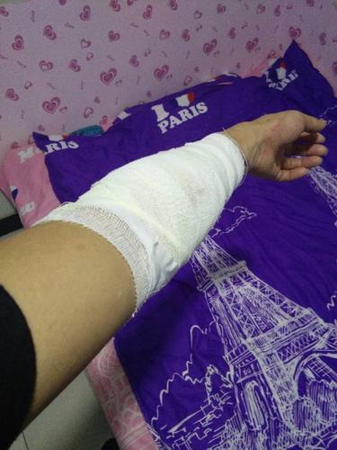 手臂受伤缝了十针,多久可以拆线,多久可以恢复,会不会