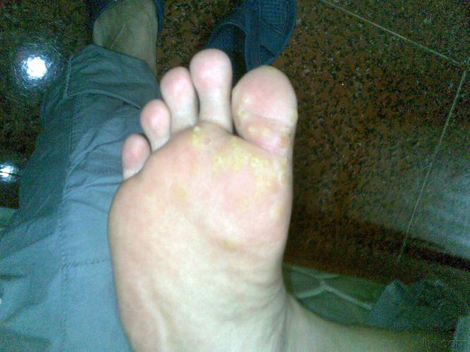 楼主sklyion2010-05-27 08:47:36         脚上长了很多有人说是疣