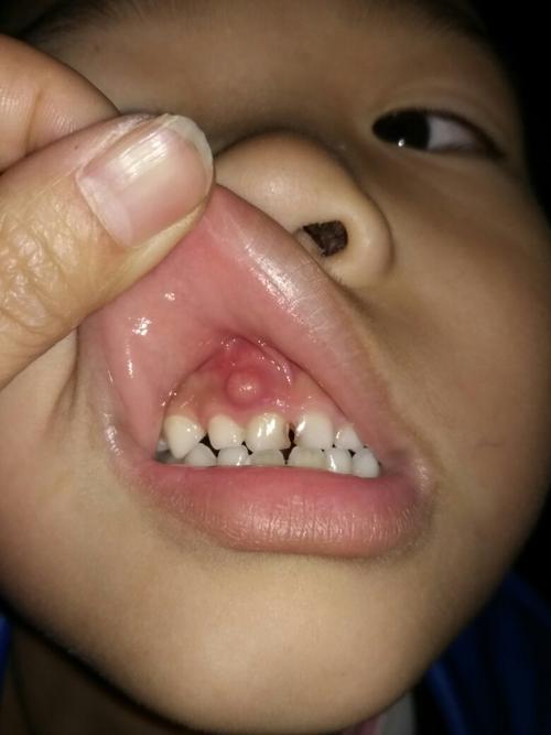 儿子7岁了牙龈上面长了一个泡一样的东西怎有