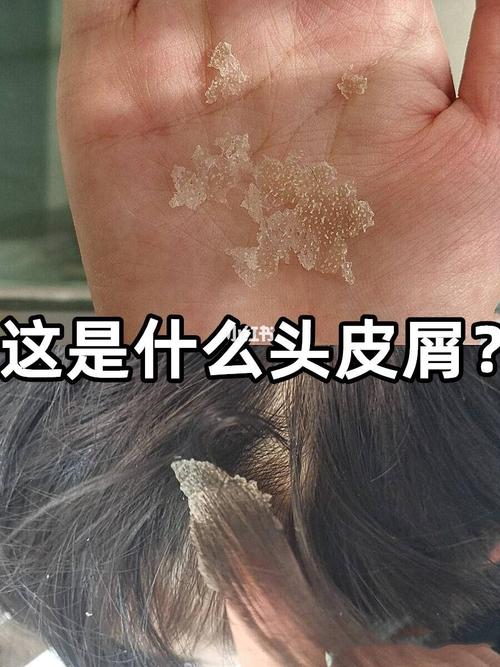这么大块头皮屑让我太自卑了01!