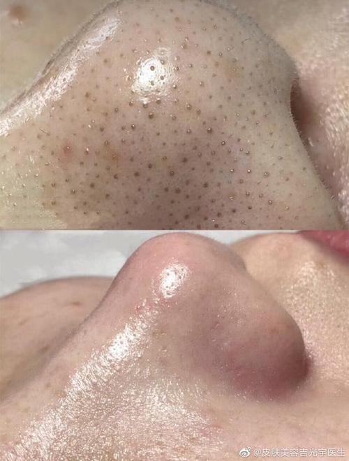 小气泡能去黑头么?