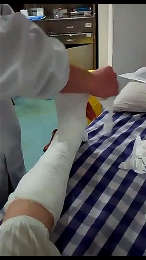 根据ct影像报告与医生再检查,确定脚环骨折,立即打上石膏