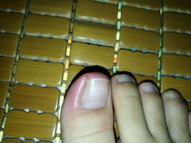 甲沟炎的最佳治疗方法有哪些我们怎样才可以彻底治疗甲沟炎