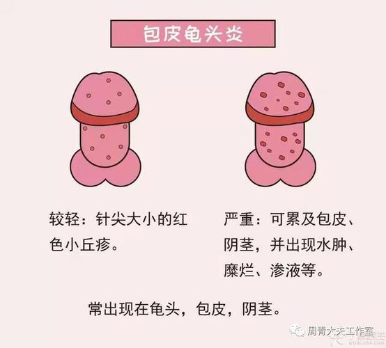 睾丸|炎症|阴囊_网易订阅