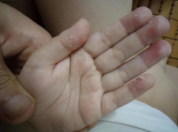 宝宝出现手指脱皮,家长别担心,教你几个有效的小偏方