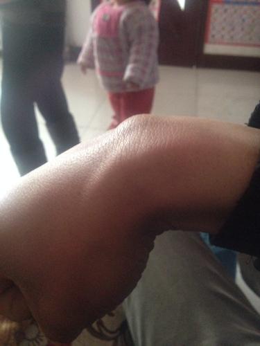 "手腕出现一个疙瘩,有点硬,怎么回事儿?