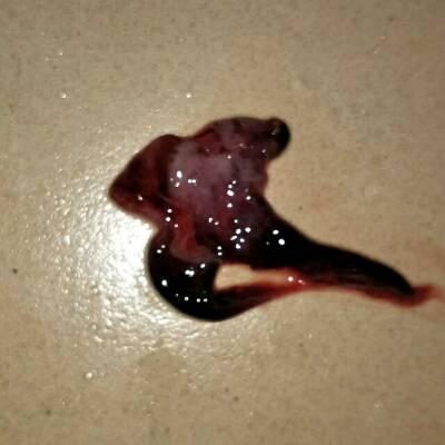 昨天来月经,今天排出一个肉肉东西.请问是不是流产
