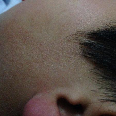 十岁小男孩脸部两侧长出鸡皮疙瘩一样的痘痘,不痒,就是红,摸起来很糙