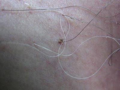 阴虱的症状特征是什么 - 症状 - 阴虱 - 北京京城皮肤医院_北京皮肤病