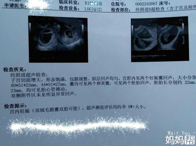 双胞胎宝宝快3个月,这是一个月前的b超单