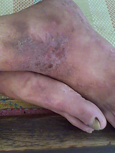 问:您好,医师, 是脚踝背有癣,皮肤分泌出黄色液体,有轻微的肿 去年6