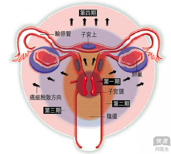 一,下面子宫疾病 宫颈癌    ((1)手术治疗: 主要用于治疗早期的