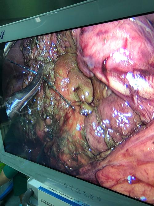 普外科微创治疗胃穿孔(胃后壁穿孔)