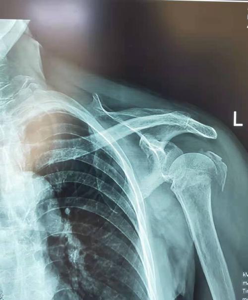 王女士左肱骨近端骨折.(术前照片)