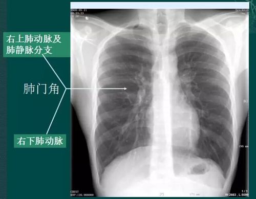 右肺门可分为上,下两部.