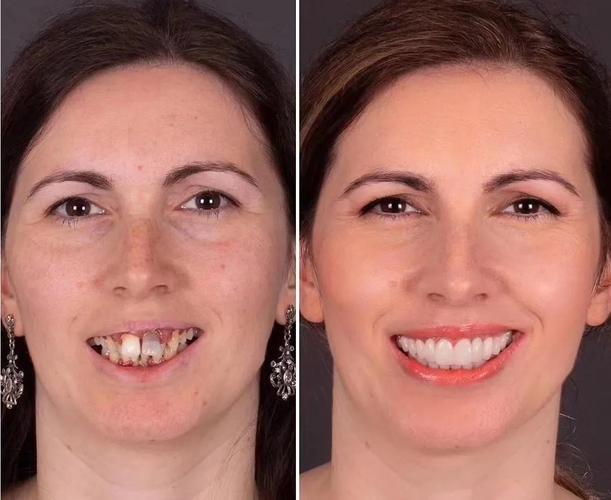 牙齿有缺失问题,且形态颜色不好看,可以考虑做 种植修复与美学修复