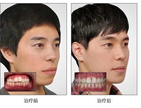 因此,很多龅牙患者想要做龅牙矫正,对于牙齿矫正,大家除了关注龅牙