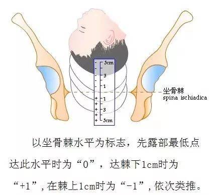 ③确定先露部下降程度 以坐骨棘水平为标志,先露部最低点达此水平时