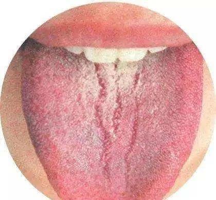 网易首页>网易号>正文申请入驻> 可能与食管癌胃癌有关裂纹舌