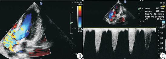 增强ct见:主动脉瓣呈拱顶状凸向主动脉窦部,收缩期主动脉瓣呈"鱼口状"