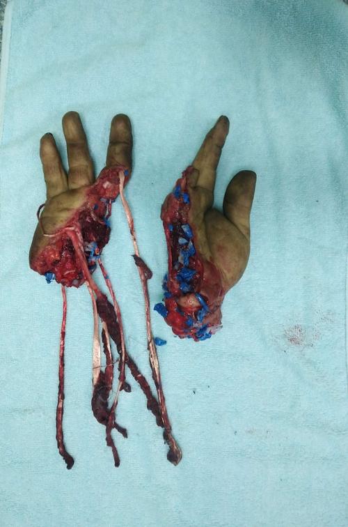 患者刘xx,在家干活时被机器轧伤,导致右手自腕部离断,手掌离断,血管