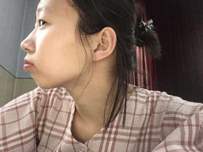 整牙两个月的侧脸,蛮丑的