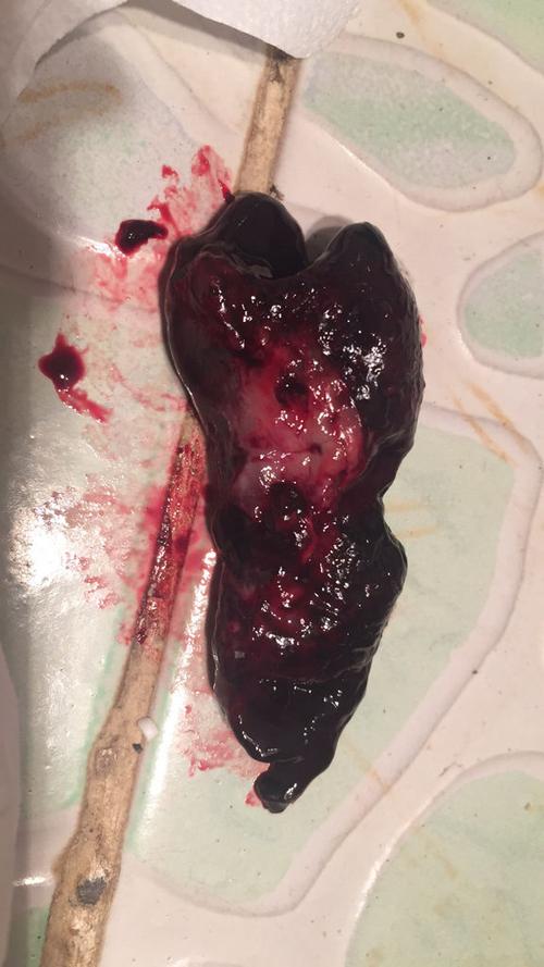 顺产后7天 卫生巾上面有肉块 跟的果冻一样的是怎么回事?