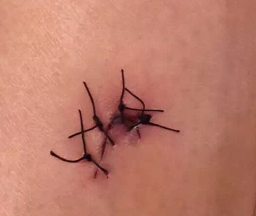 医生说十二天拆线.平常不疼不痒的.昨天打开一看伤口还没愈合.