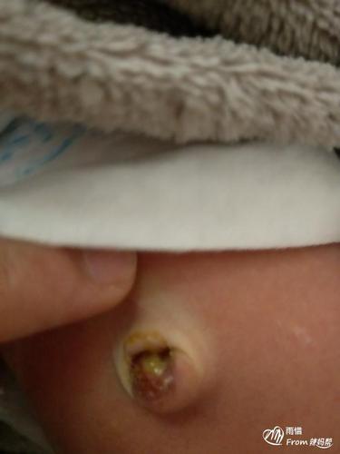 新生儿肚脐眼有黄脓怎么办?-宝宝健康帮-辣妈帮