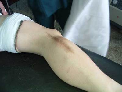 骨癌患者有哪些饮食注意事项