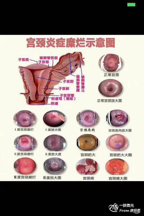 宫颈糜烂可怕吗?