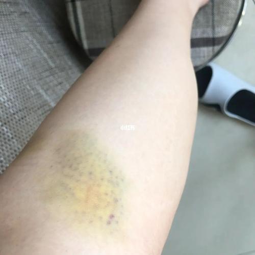 有一样的姐妹吗02_腿部淤青_生活记录_接地气生活