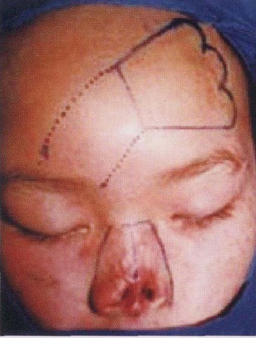 典型病例:以右侧滑车上血管为蒂的左侧额部皮瓣法全鼻再造术