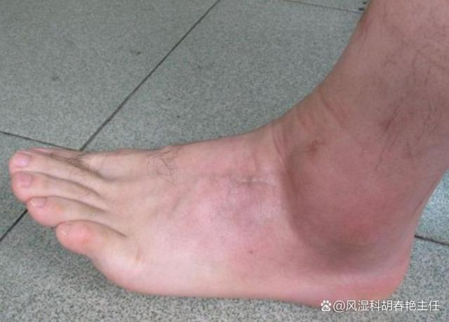踝关节肿胀一般需要注意避免关节压力,踝关节肿胀通常与局部扭伤或