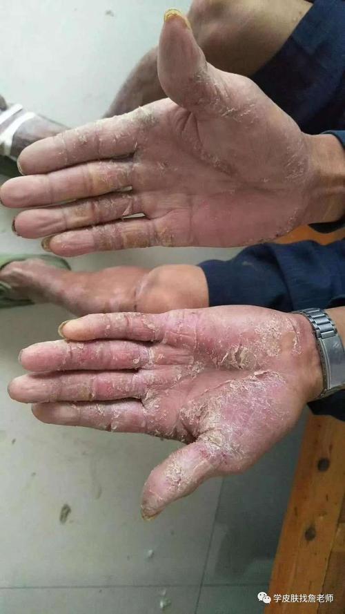 结果不但祛除不了病根,                     一 认识手癣:真菌性皮肤