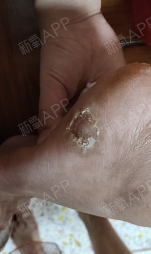 掌跖部位的脓疱和脓痂,反复发作,久治不愈的,要怀疑掌跖脓疱病的可能