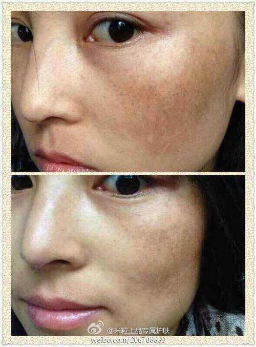 为什么产后的女人爱长斑?