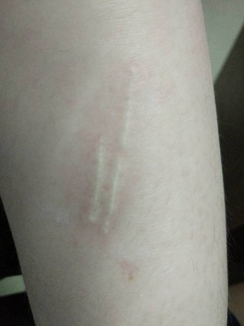 被老鼠爪子抓伤了,没流血,有点破皮,已涂过消毒水,之后就变成下图