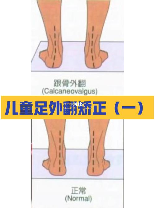 并且干预治疗的时间越早,小儿足外翻预后效果越明显