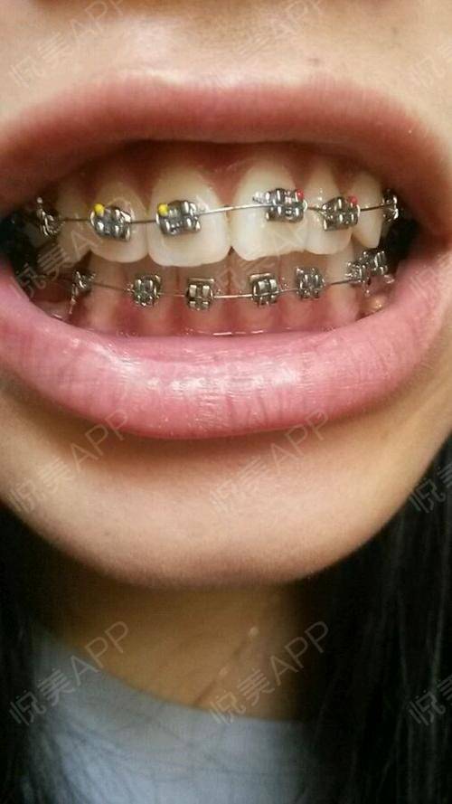 金属托槽矫正手术当天_隐形矫正手术当天_牙齿矫正手术当天_牙齿美容