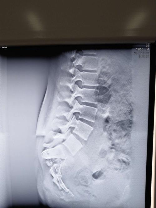 骶骨骨折会诊,分型?手术方案?固定方式?急诊手术还是择期?