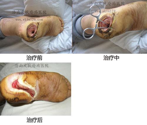 慢性骨髓炎患者:常某某(图)