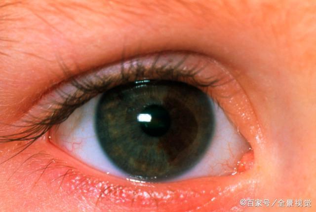 眼睛出现8种症状,可能是黑色素瘤来临,早发现早