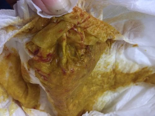 宝宝大便带血怀疑蛋白质过敏